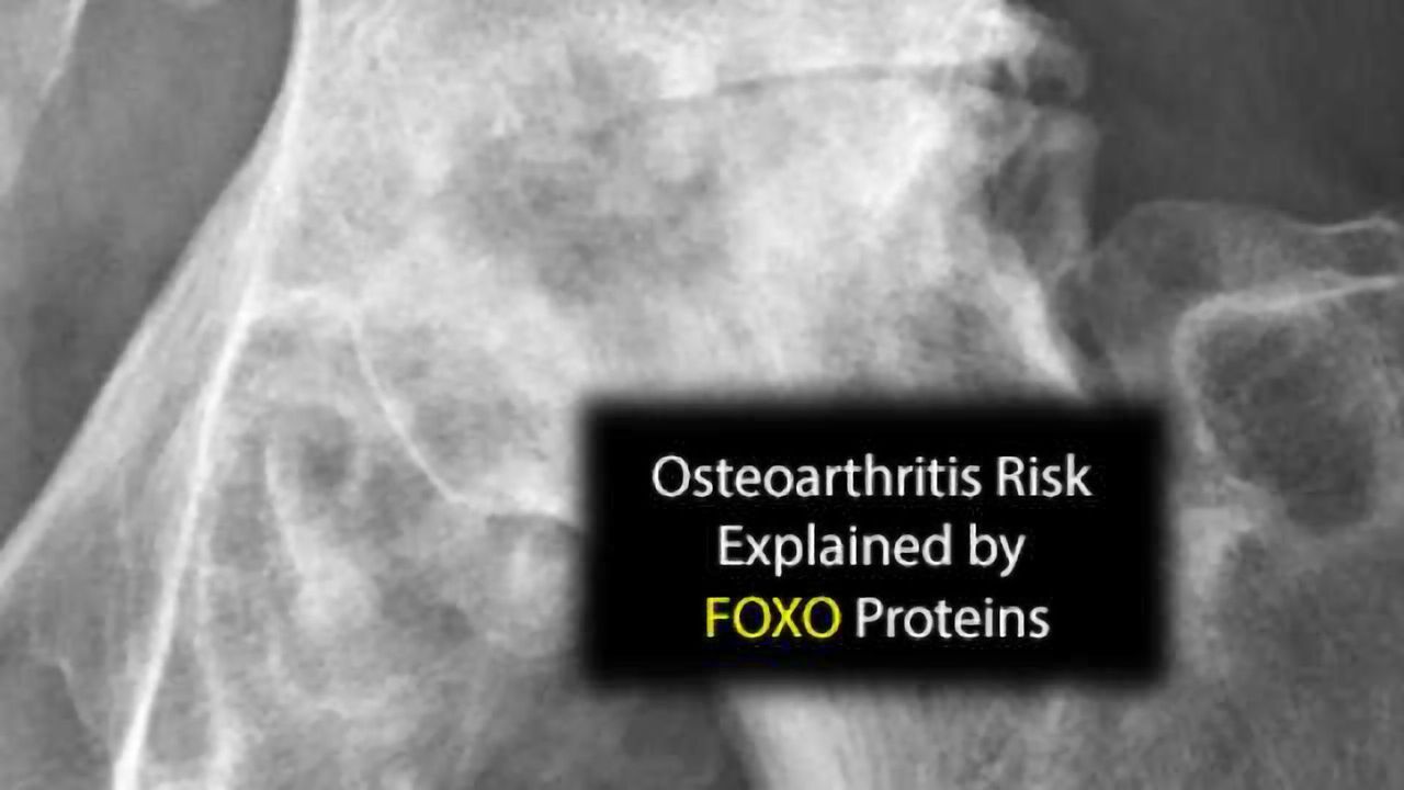 FoxO Proteins Implicated in Arthritis Age Risk