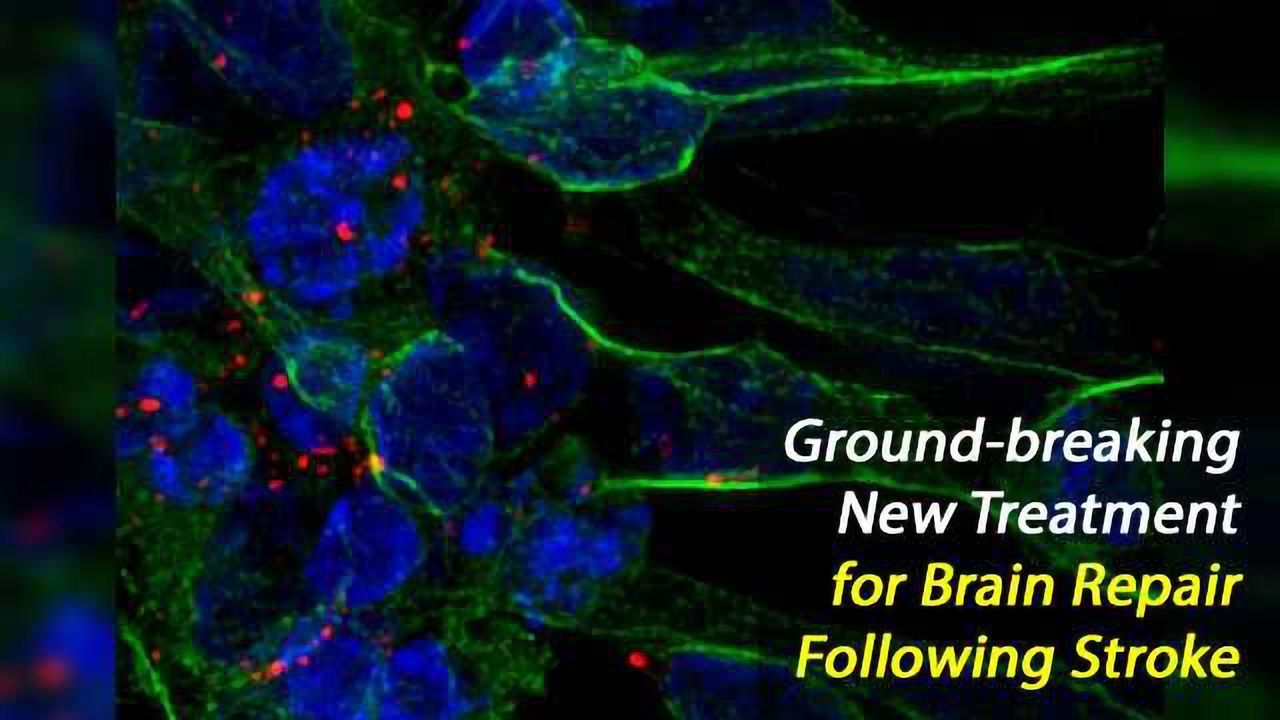Stem-Cell Exosome Treatment Repairs Brain Damage Following Stroke