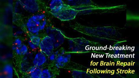 Stem-Cell Exosome Treatment Repairs Brain Damage Following Stroke