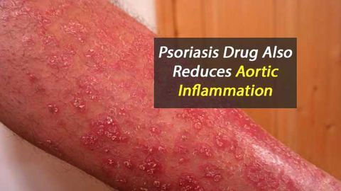 Psoriasis Drug Also Reduces Aortic Inflammation