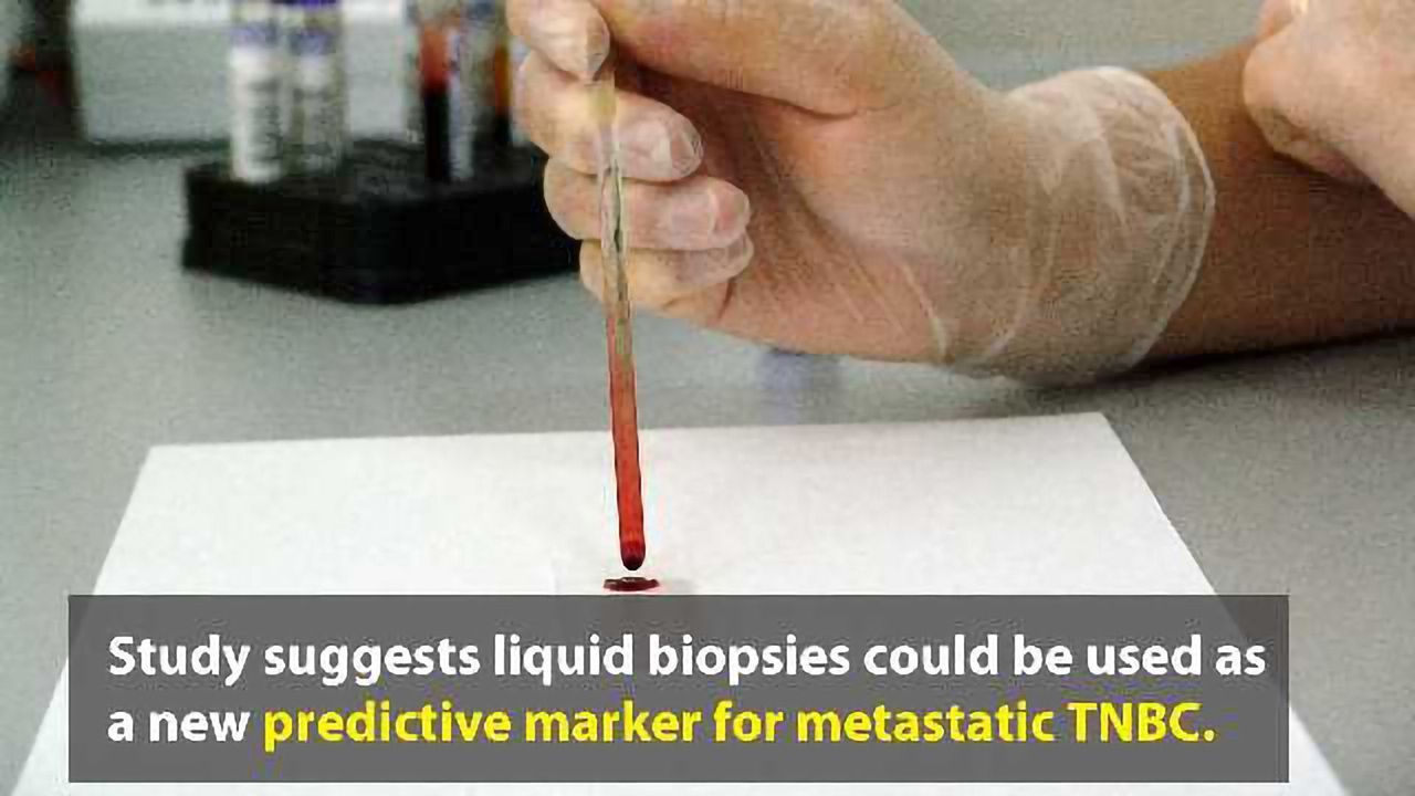 Liquid Biopsy Can Help Predict Outcomes in Metastatic Triple-Negative Breast Cancer