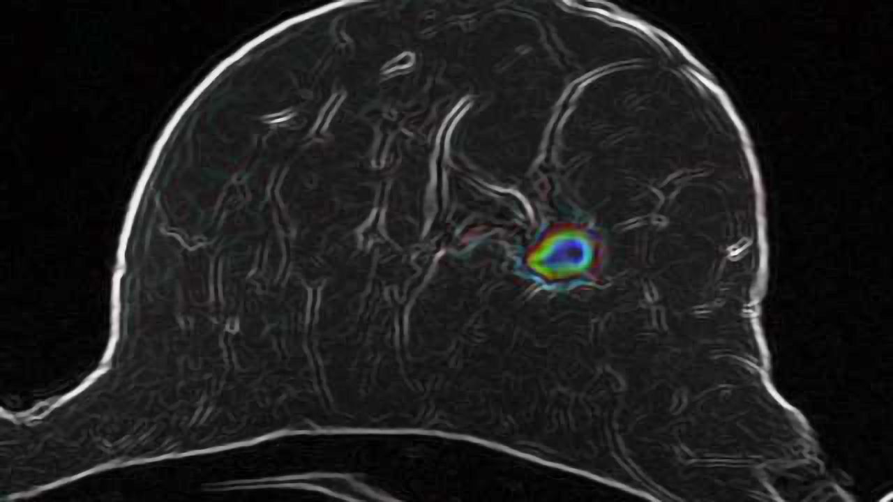 Breast Cancer: How Advanced Imaging Technologies Will Help Avoid Unnecessary Biopsies