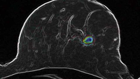 Breast Cancer: How Advanced Imaging Technologies Will Help Avoid Unnecessary Biopsies