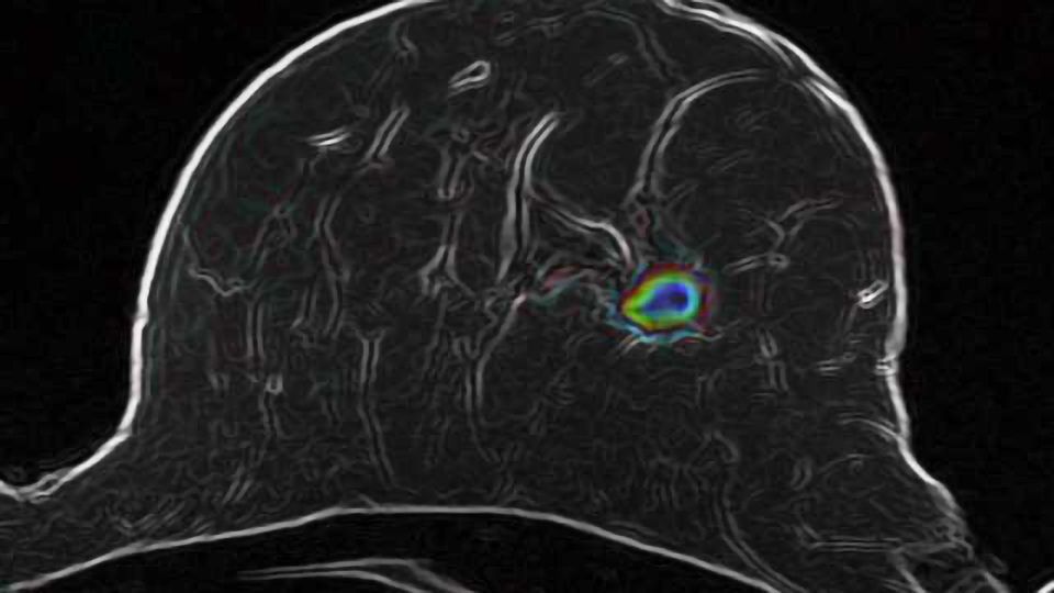 Breast Cancer How Advanced Imaging Technologies Will Help Avoid Unnecessary Biopsies