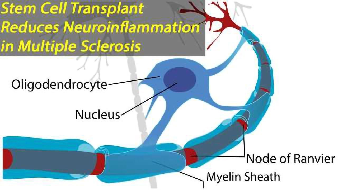 Transplanting Stem CellsDirectly into the Cerebrospinal Fluid Reduces the Amount of Succinate, Reprograms Macrophages and Microglia