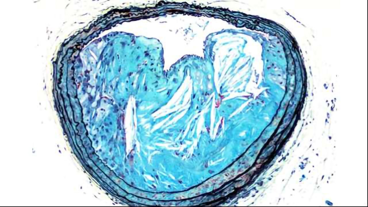 New Strategy Against Vascular Disease in Diabetes?