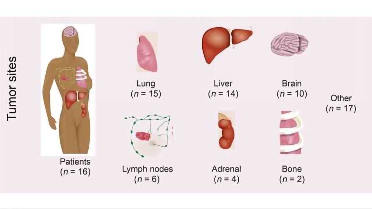 Genetic ‘Seeds’ of Metastatic Breast Cancer Identified