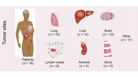 Genetic ‘Seeds’ of Metastatic Breast Cancer Identified