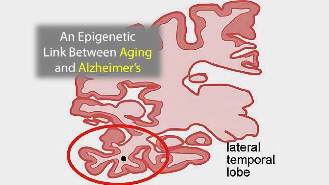 An Epigenetic Link Between Aging and Alzheimer's