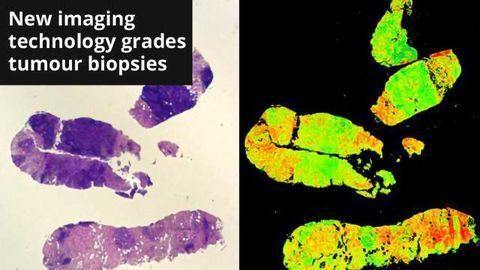 ‘Digistain’ Technology Offers Revolution in Detailed Cancer Diagnosis