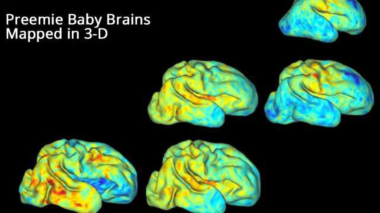 Scientists 3-D Map Premature Babies’ Brain Growth
