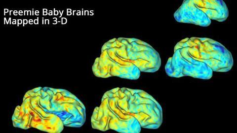 Scientists 3-D Map Premature Babies’ Brain Growth