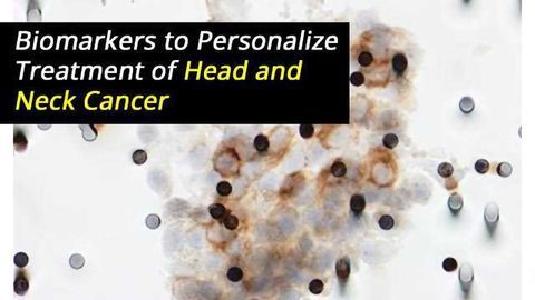 Biomarkers to Personalize Treatment of Head and Neck Cancer