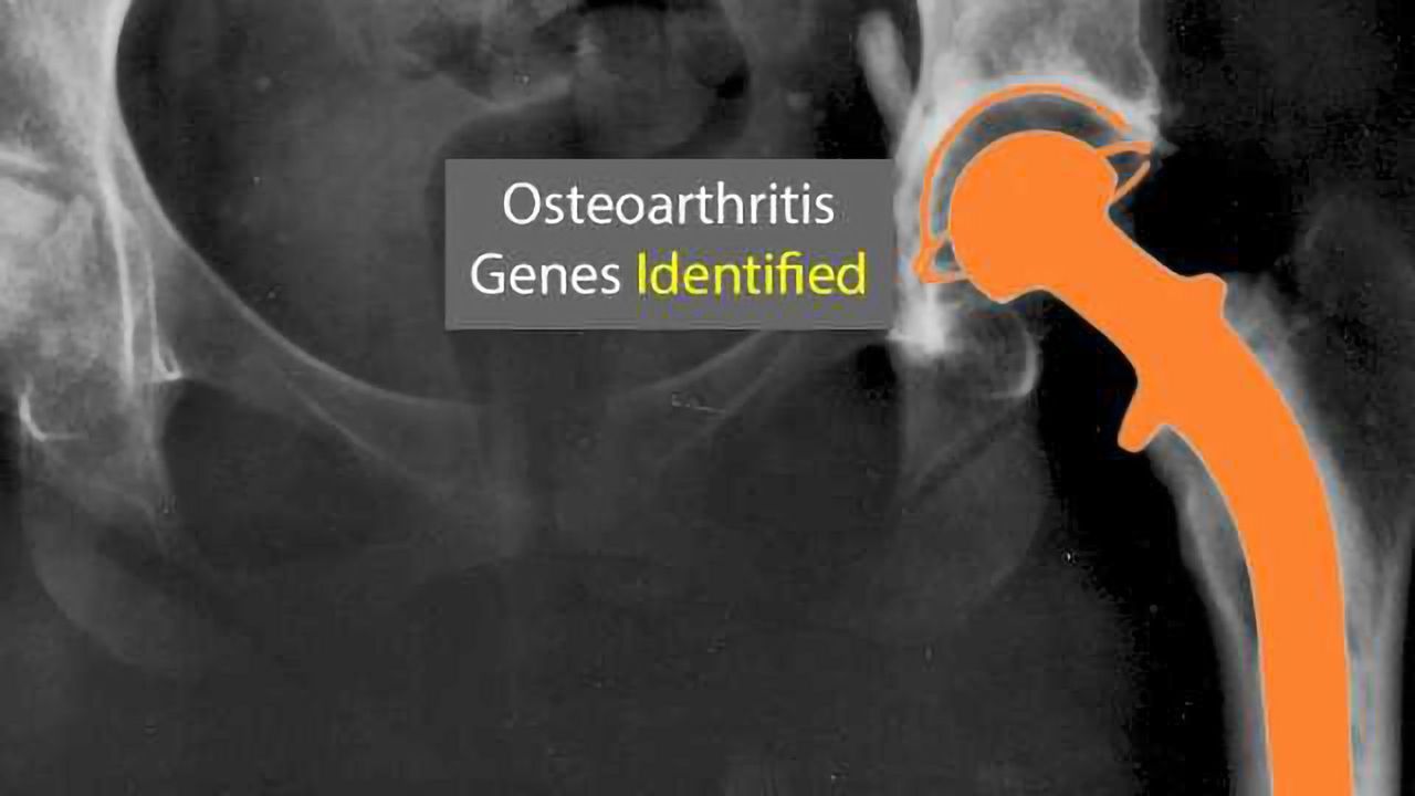 Largest Genetic Study of Osteoarthritis Advances Research