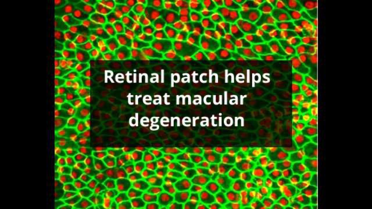 Stem Cells Treat Macular Degeneration