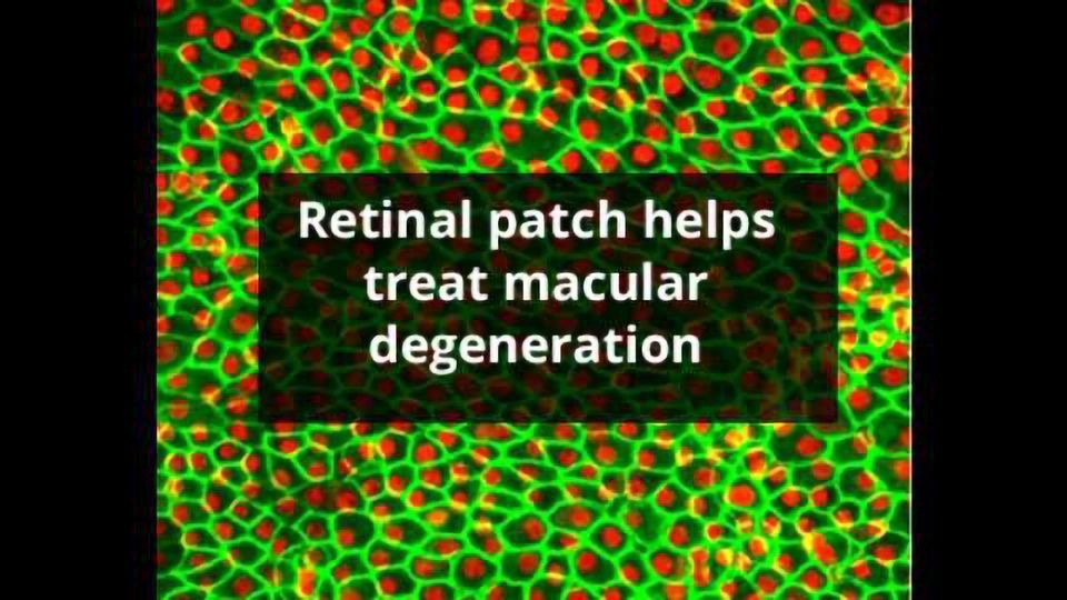 Stem Cells Treat Macular Degeneration Technology Networks