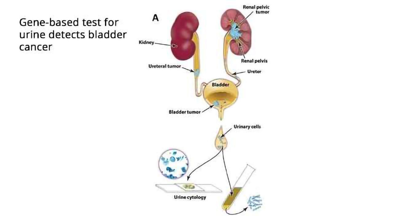 UroSEEK Enables Noninvasive Detection of Bladder Cancer