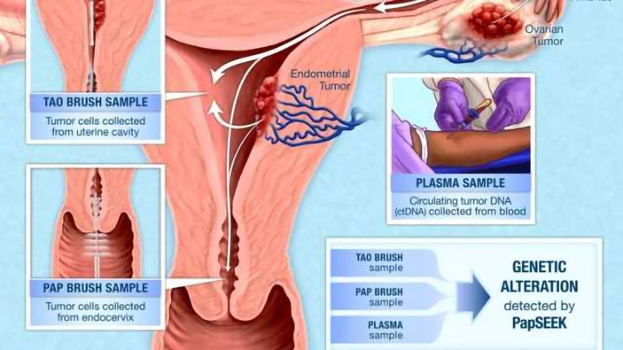 Pap Test Fluids Used to Test for Endometrial & Ovarian Cancers