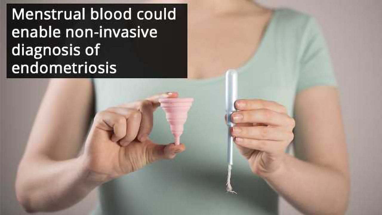Stem Cells in Menstrual Blood Could Help Diagnose Endometriosis
