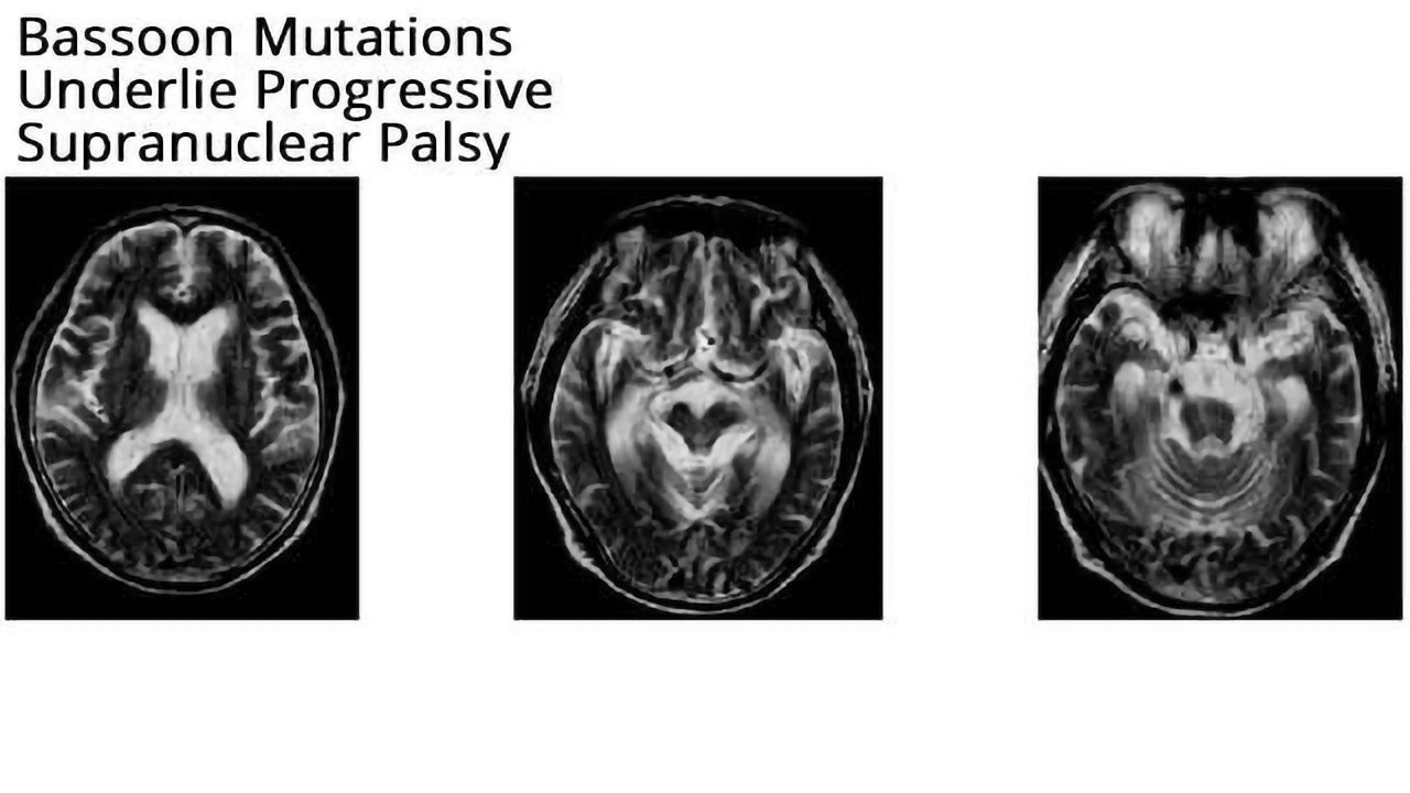 Mutations in Bassoon Gene Underlie Progressive Supranuclear Palsy