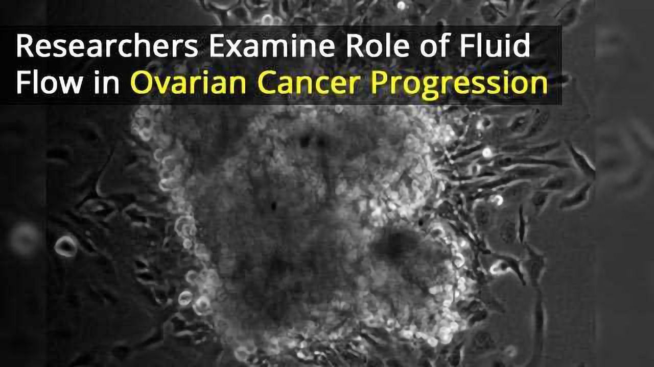The Role of Fluid Flow in Ovarian Cancer Progression