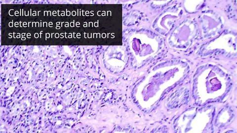 Metabolic Profiling May Determine Aggressiveness, Prognosis of Prostate Cancer