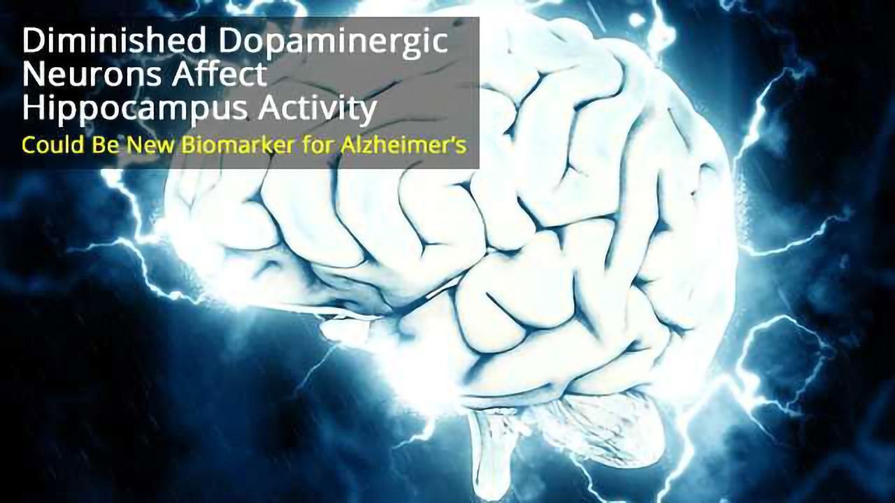 Detecting Diminished Dopamine-firing Neurons Could Reveal Earliest Signs of Alzheimer’s Disease