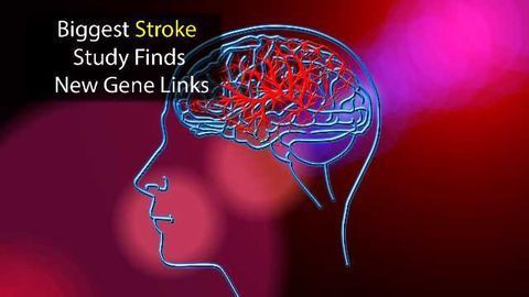 Largest Stroke Study Ever Identifies 22 New Genetic Links
