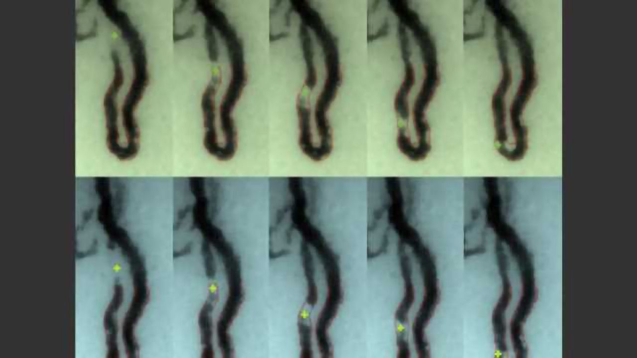 Monitor Detects Dangerously Low White Blood Cell Levels