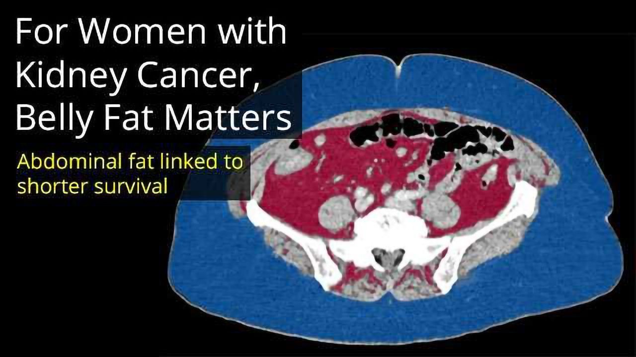 For Women with Kidney Cancer, Belly Fat Matters