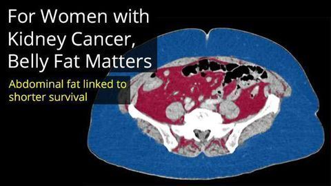 For Women with Kidney Cancer, Belly Fat Matters