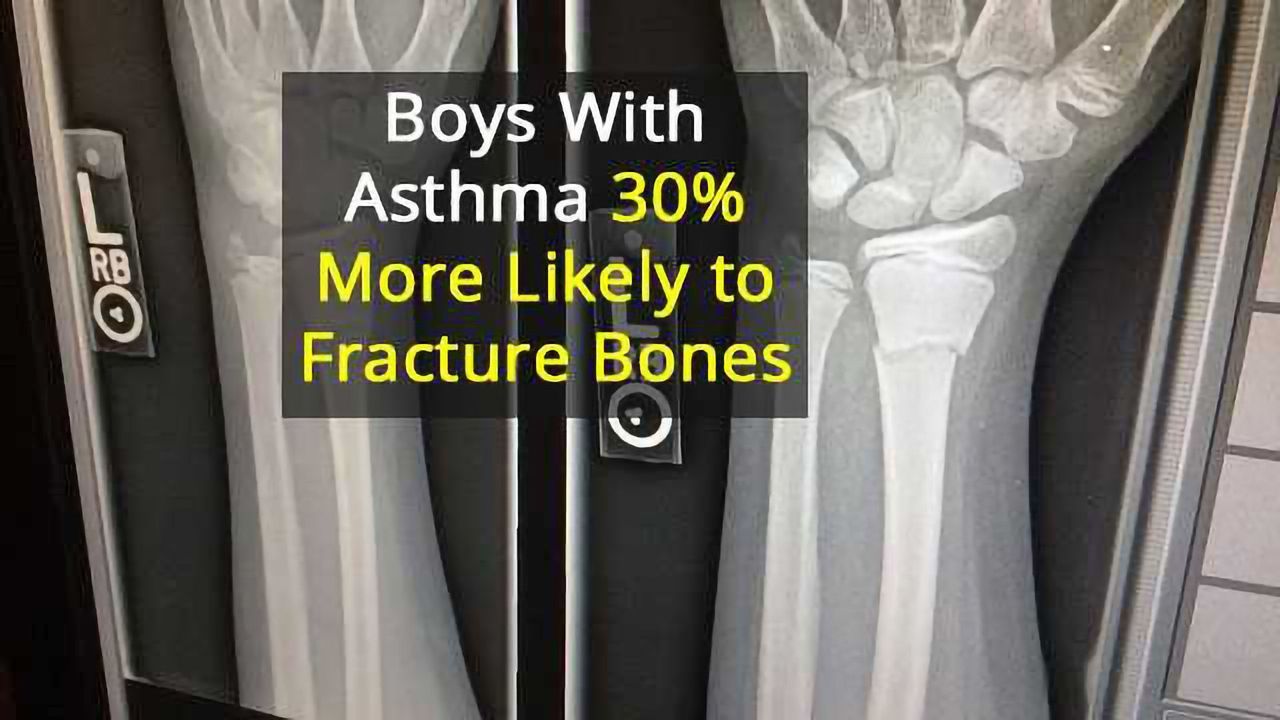 Asthma is Associated with Boys’ Childhood Fractures