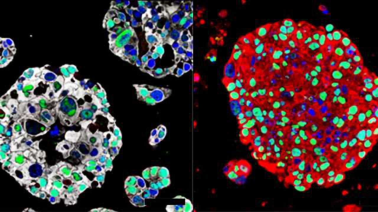 Organoids Created from Patients’ Bladder Cancers Could Guide Treatment
