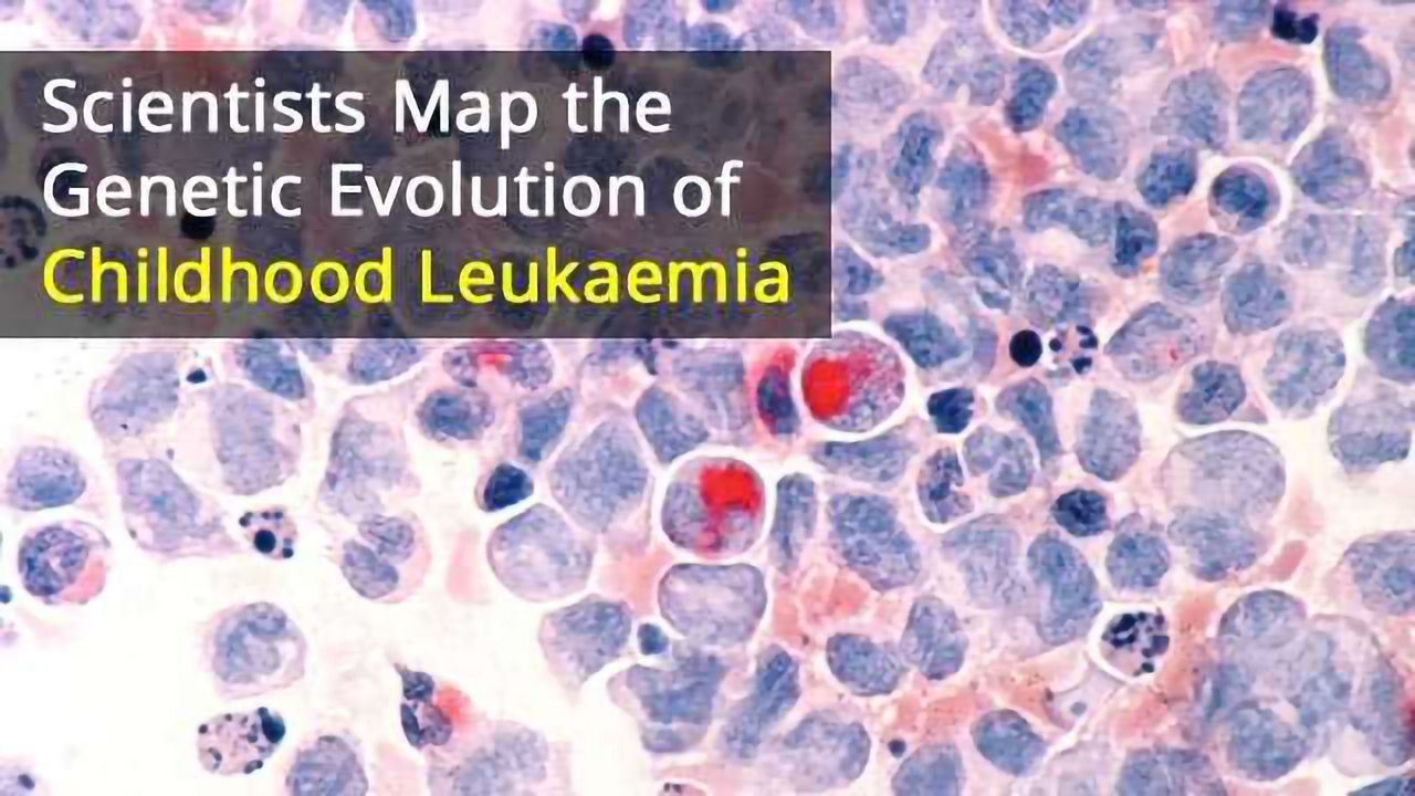 Mutation May Trigger Development of Childhood Leukaemia