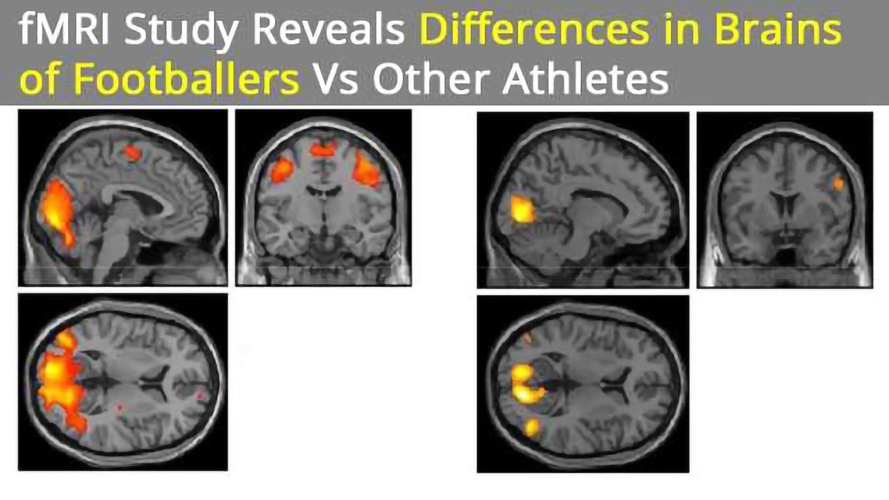 Brain Differences Found in Athletes Playing Contact vs Noncontact Sports