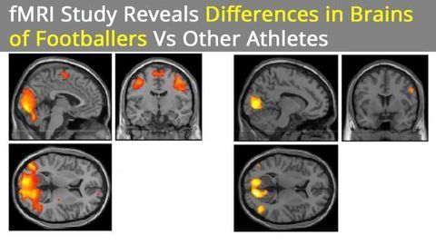 Brain Differences Found in Athletes Playing Contact vs Noncontact Sports