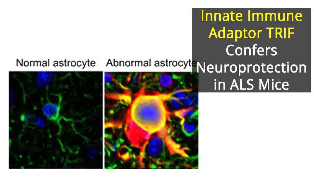Deficiency of Innate Immune Adaptor TRIF Linked to Neurodegeneration