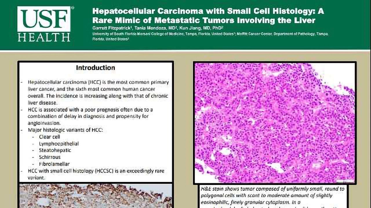 Hepatocellular Carcinoma with Small Cell Histology: A Rare Mimic of Metastatic Tumors Involving the Liver
