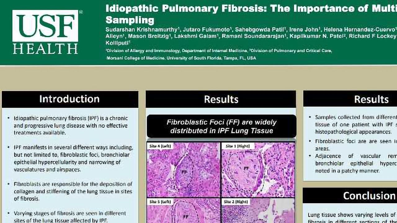 Idiopathic Pulmonary Fibrosis: The Importance of Multiple-site Sampling
