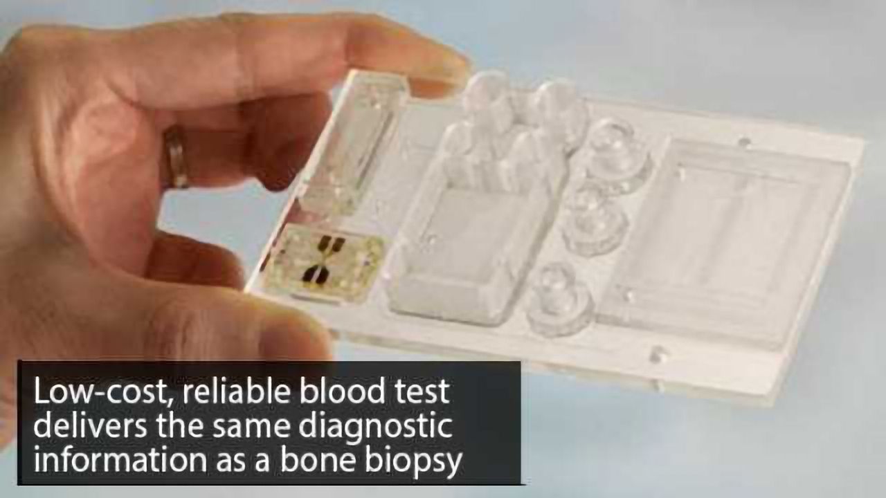 Liquid Biopsy Developed for Multiple Myeloma