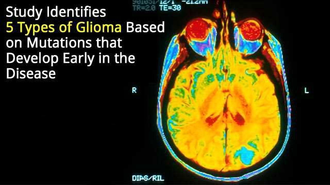 Five Sub-types of the Brain Cancer Glioma Identified