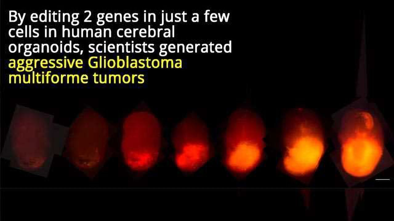 Gene-edited Organoids Reveal How Deadly Brain Cancer Grows