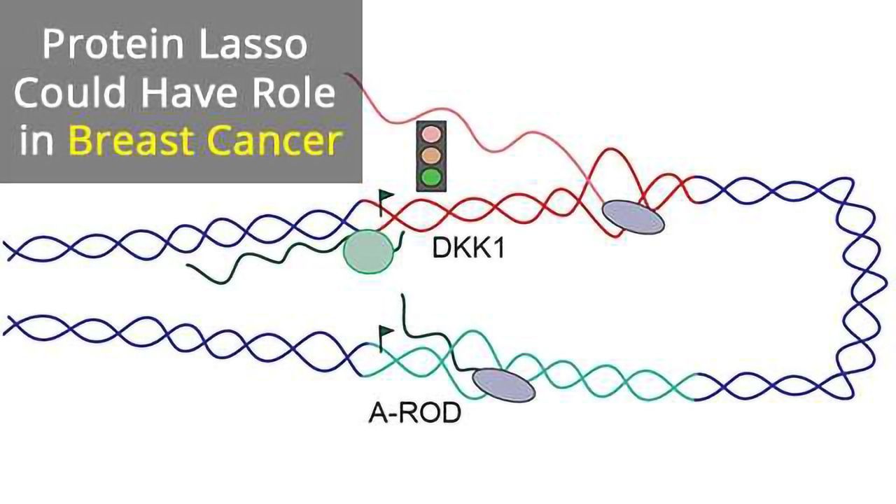 The Protein Lasso Implicated in Breast Cancer