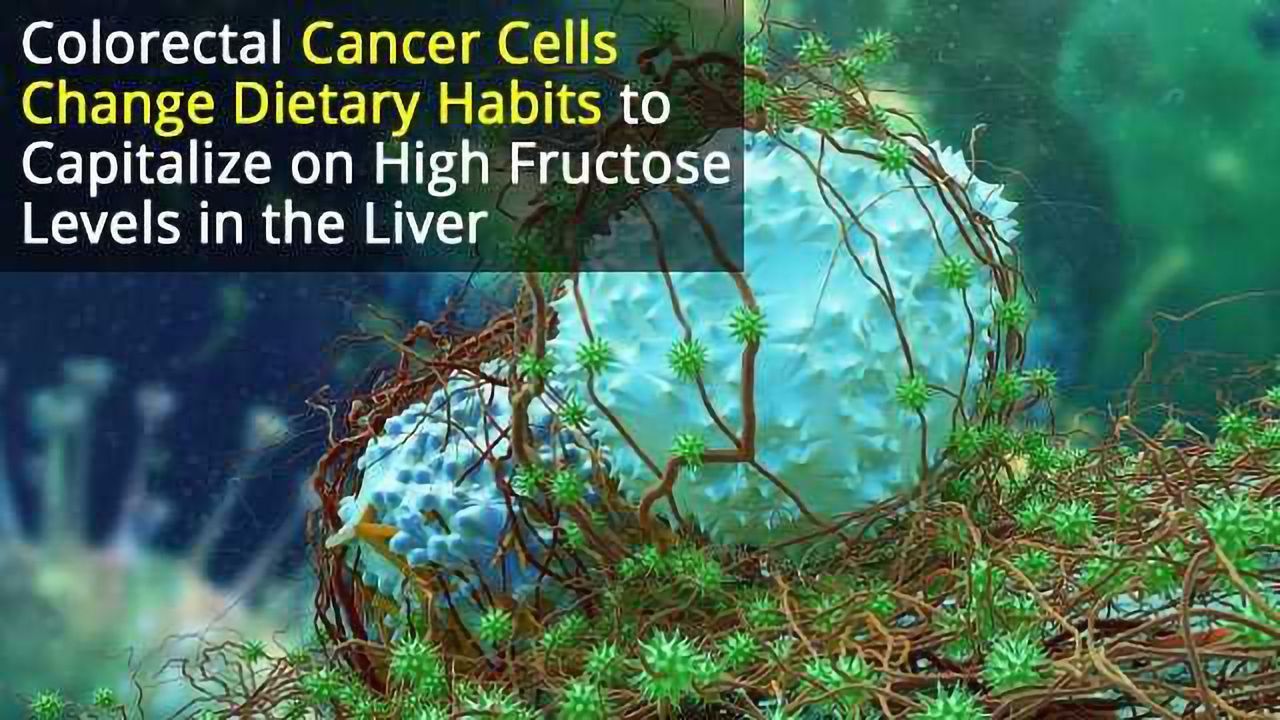 Metastatic Cancer Gorges on Fructose in the Liver