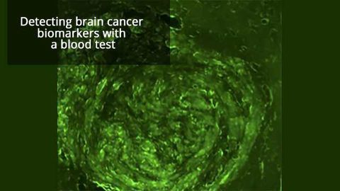 Noninvasive Brain Tumor Biopsy on the Horizon