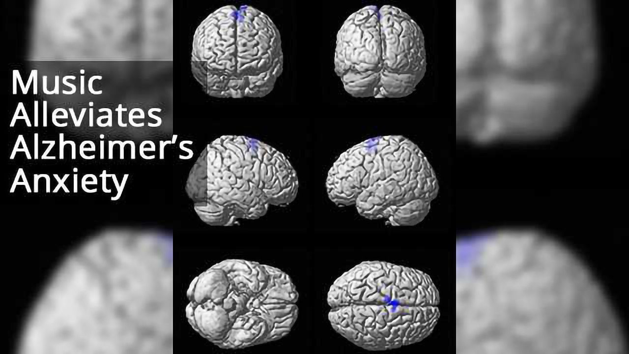 Music Activation of Salience Network Could Alleviate Anxiety in Alzheimer's Disease