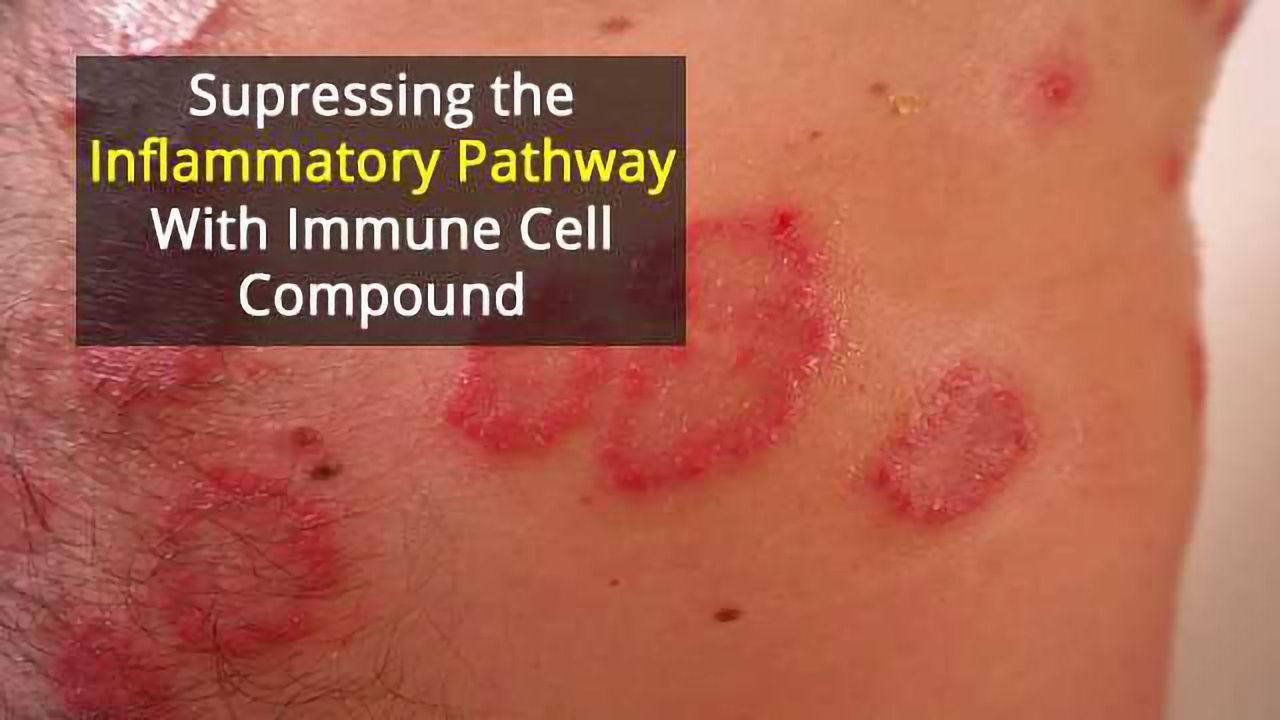 Immune Cell Compound Used To Treat Psoriasis
