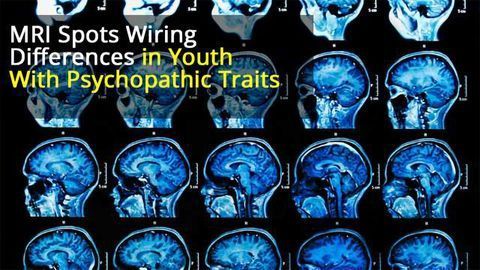 MRI Study Shows Brains of Young People With Severe Behavioural Problems ‘Wired Differently’