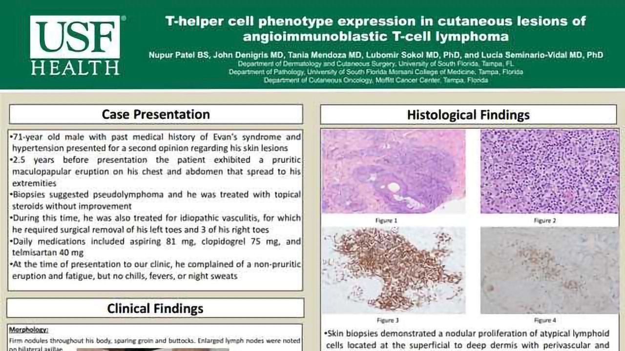 T-helper cell phenotype expression in cutaneous lesions of angioimmunoblastic T-cell lymphoma