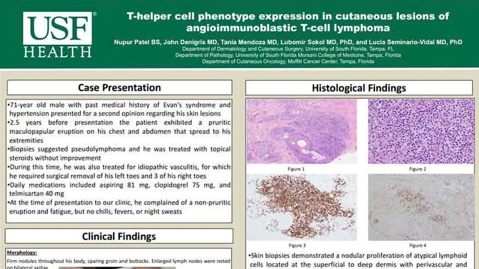 T-helper cell phenotype expression in cutaneous lesions of angioimmunoblastic T-cell lymphoma  content piece image